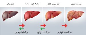 کبد چرب و کبد سالم چه تفاوتی با هم دارند